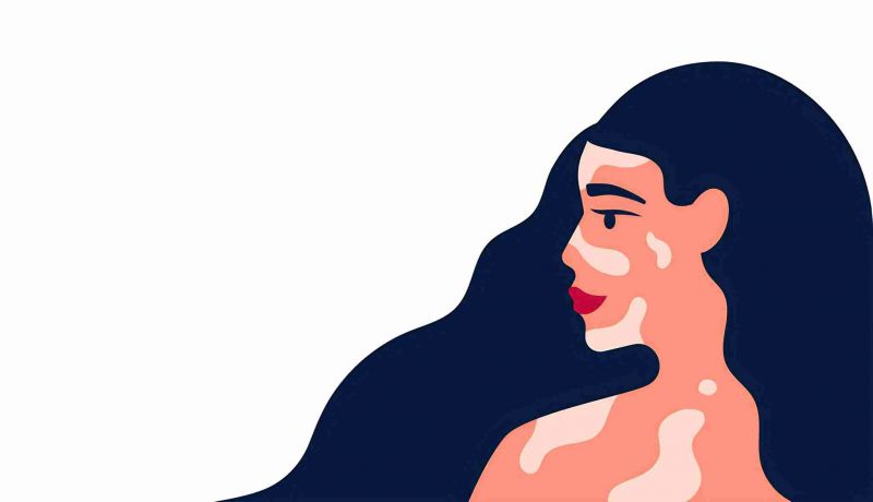 医院咨询：酒泉白癜风医院哪家好 女性有白癜风护理要怎么做